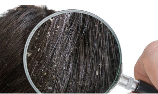 Top 4 Best Home Remedies for Dandruff-free Scalp that Works like a Magic Potion!