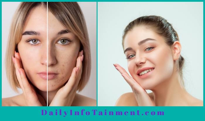 Tips To Get 99% Acne Free Face